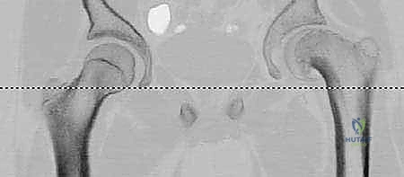 العوامل المسببة لانزلاق رأس الفخذ المشاشي