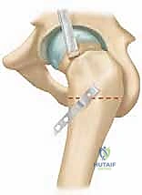 إجراء قطع العظم بدقة عالية