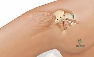 استراتيجيات العلاج الجراحي المتقدم