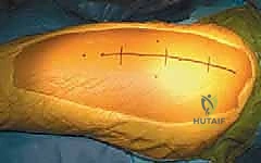 التخطيط الجراحي الدقيق قبل العملية