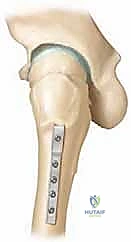 الأستاذ الدكتور محمد هطيف في غرفة العمليات