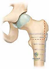 تثبيت العظم باستخدام الشرائح والمسامير المتقدمة
