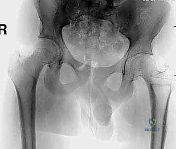 Flexion Intertrochanteric Osteotomy for Severe Slipped Capital Femoral Epiphysis: An Intraoperative Masterclass