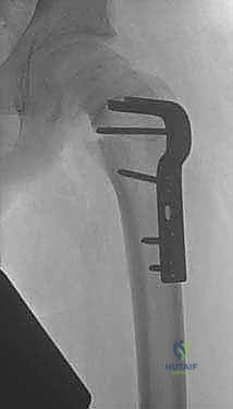 المرحلة الأولى من إعادة التأهيل والعلاج الطبيعي