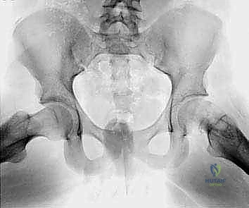 قطع العظم الانثنائي بين المدورين لعلاج انزلاق رأس الفخذ المشاشي الشديد: استعادة الحركة بلا ألم