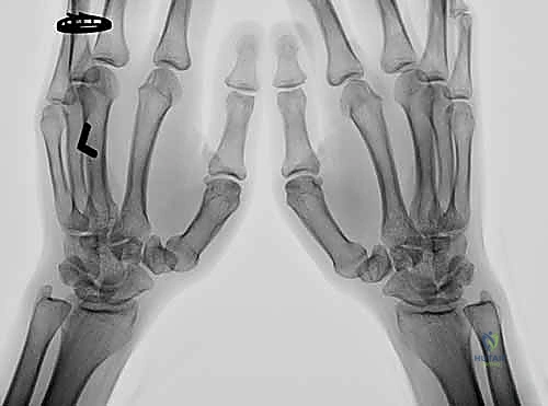 توضيح التشريح والفسيولوجيا المرضية لمفصل الإبهام