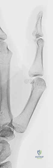 خطوات جراحة إطالة عظم المشط وتثبيت العظم