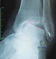 تعديل استقامة العظام قبل التثبيت