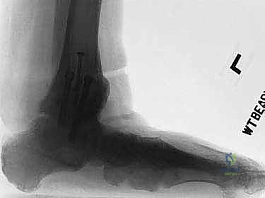 صورة توضيحية لـ تثبيت مفصل الكاحل والقدم الخلفية بالمسمار النخاعي: استعادة الحياة بدون ألم وثبات دائم