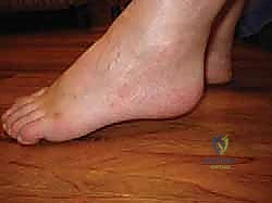 صورة توضيحية لـ تثبيت مفصل الكاحل والقدم الخلفية بالمسمار النخاعي: استعادة الحياة بدون ألم وثبات دائم