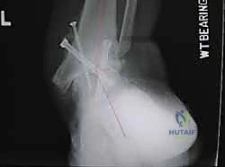 صورة توضيحية لـ تثبيت مفصل الكاحل والقدم الخلفية بالمسمار النخاعي: استعادة الحياة بدون ألم وثبات دائم