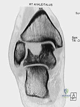 Illustration of medullary nail fixation - Dr. Mohammed Hutaif