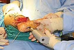 صورة توضيحية لـ تثبيت مفصل الكاحل والقدم الخلفية بالمسمار النخاعي: استعادة الحياة بدون ألم وثبات دائم