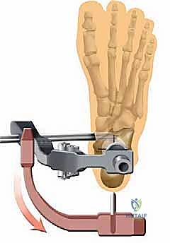 تثبيت المسمار بالبراغي القفلية