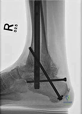 الأحذية الطبية الداعمة للكاحل