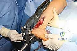 صورة طبية: تثبيت مفصل الكاحل والقدم الخلفية بالمسمار النخاعي: استعادة الحياة بدون ألم وثبات دائم