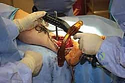 تثبيت مفصل الكاحل والقدم الخلفية بالمسمار النخاعي: استعادة الحياة بدون ألم وثبات دائم