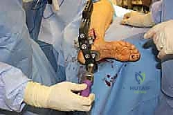 الحقن الموضعية والعلاجات التحفظية