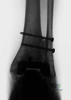 الأستاذ الدكتور محمد هطيف رائد جراحة العظام في صنعاء