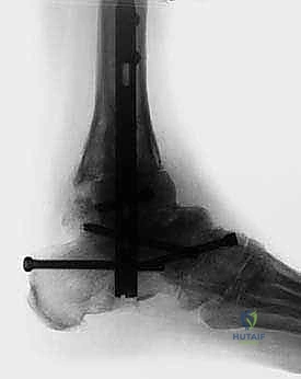 صورة شعاعية أثناء العملية للتأكد من الموضع