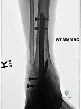 صورة توضيحية لـ تثبيت مفصل الكاحل والقدم الخلفية بالمسمار النخاعي: استعادة الحياة بدون ألم وثبات دائم