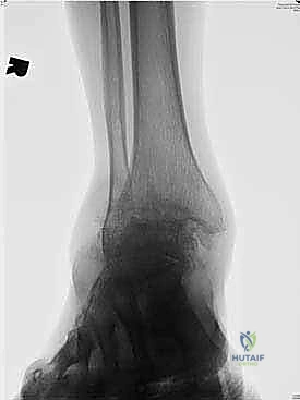 صعوبة المشي والاعتماد على العكازات