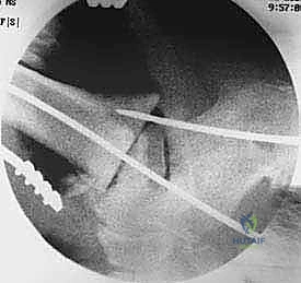 صورة توضيحية لـ تثبيت مفصل الكاحل والقدم الخلفية بالمسمار النخاعي: استعادة الحياة بدون ألم وثبات دائم