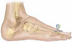 تفاصيل تشريحية لمفاصل القدم الخلفية المستهدفة في عملية الدمج الثلاثي