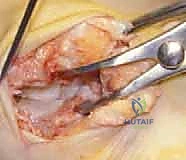 صورة توضح مفهوم دمج العظام في القدم الخلفية وإزالة الغضاريف التالفة