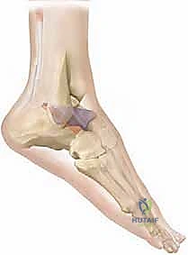 حالة تشوه شديد في القدم تستدعي التدخل الجراحي بالدمج الثلاثي