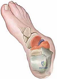 الأشعة السينية توضح التآكل المفصلي والتشوه قبل الجراحة