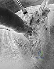 إغلاق الشقوق الجراحية ووضع الجبيرة الأولية