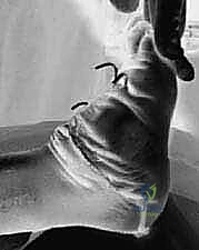 إعادة محاذاة العظام وتصحيح التشوه الهندسي للقدم