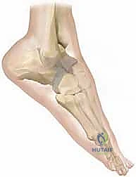 استخدام المسامير الطبية المصنوعة من التيتانيوم لتثبيت العظام