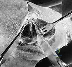 الشقوق الجراحية والوصول إلى المفاصل المستهدفة