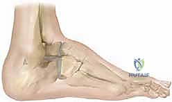 صورة توضيحية لـ دمج مفاصل القدم الثلاثي: حل متقدم لتشوهات القدم المعقدة مع الأستاذ الدكتور محمد هطيف في صنعاء