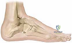 دمج مفاصل القدم الثلاثي: حل متقدم لتشوهات القدم المعقدة مع الأستاذ الدكتور محمد هطيف في صنعاء