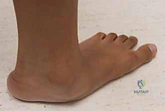 Illustration of calcaneal lengthening osteotomy - Dr. Mohammed Hutaif