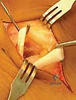 هبوط القوس الطولي للقدم