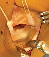 الدوران الخارجي للقدم وعلامة الكثير من الأصابع