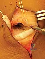 صورة توضيحية لـ جراحة إطالة عظم الكعب (عملية إيفانز)