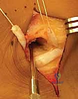 جراحة إطالة عظم الكعب (عملية إيفانز): الحل الشامل لتصحيح القدم المسطحة وتشوه الكعب الأروح مع الأستاذ الدكتور محمد هطيف في صنعاء