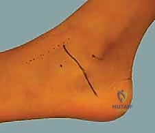 تشريح القدم المسطحة وانحراف الكعب