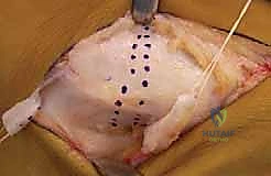 تشخيص القدم المسطحة سريرياً