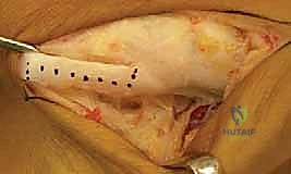 أسباب وعوامل خطر القدم المسطحة