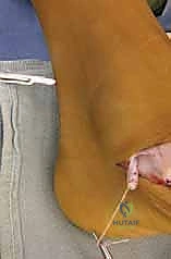 صورة أشعة توضح تشوه القدم المسطحة