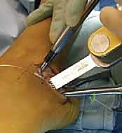 حماية الأوتار والأعصاب أثناء الجراحة