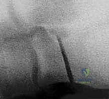 إجراء القطع العظمي في عظم الكعب