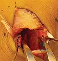 تحديد مكان الشق الجراحي