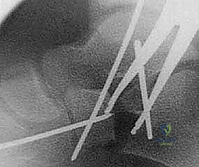 الشق الجراحي والوصول للعظم